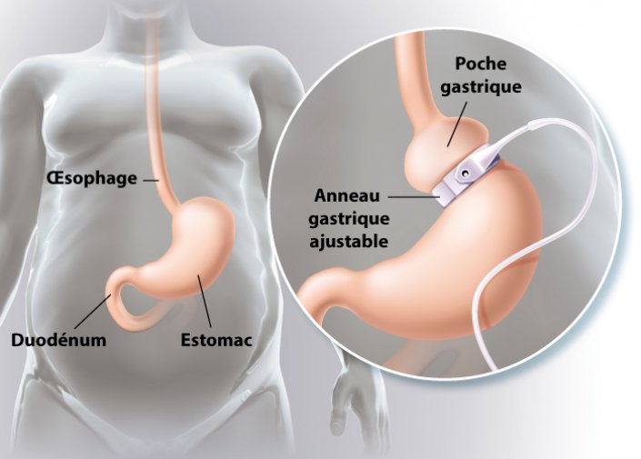 Glissement anneau gastrique symptômes : Pourquoi l’anneau ajustable échoue à long terme ?