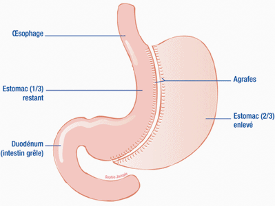 Sleeve gastrique Paris