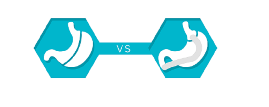 Différence entre sleeve et bypass : notre avis professionnel